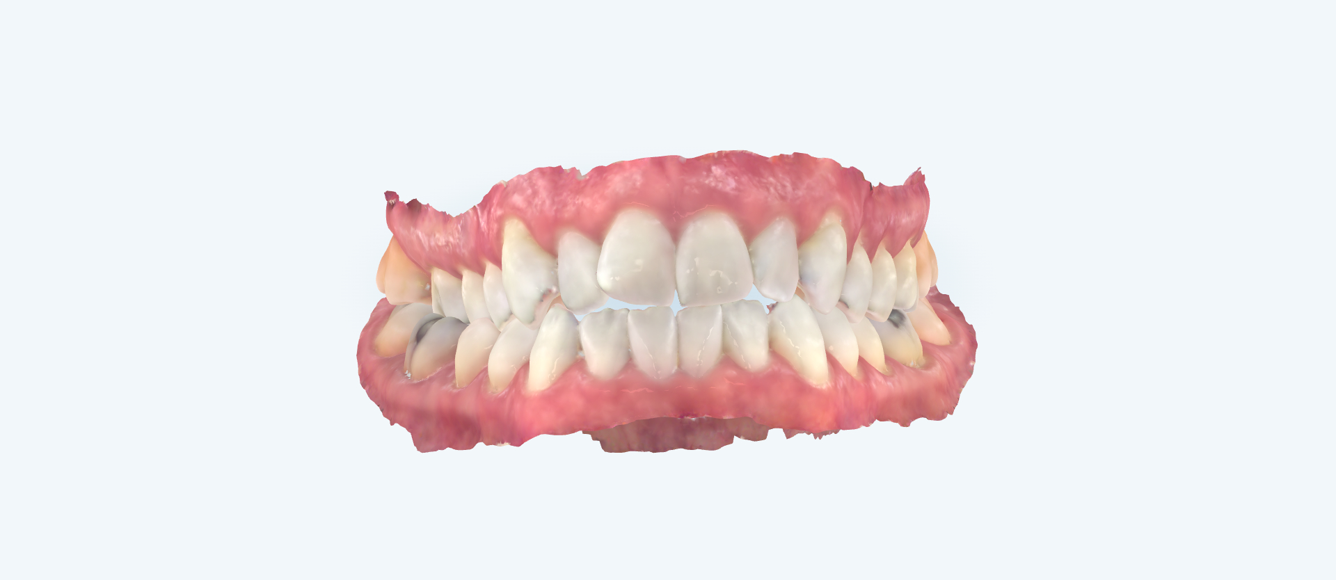 Openbite treatment comparison case 2 before